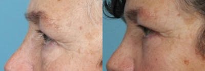 Eyelid Surgery (Blepharoplasty) Before & After Gallery - Patient 419403 - Image 4