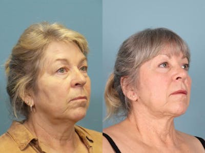 Eyelid Surgery (Blepharoplasty) Before & After Gallery - Patient 230633 - Image 1