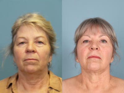 Eyelid Surgery (Blepharoplasty) Before & After Gallery - Patient 230633 - Image 2