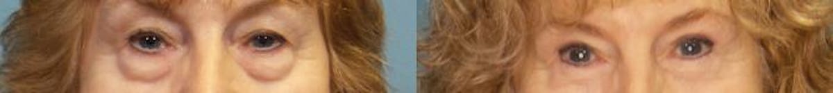 Eyelid Surgery (Blepharoplasty) Before & After Gallery - Patient 363797 - Image 1
