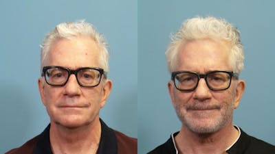 Facelift Before & After Gallery - Patient 335255 - Image 1