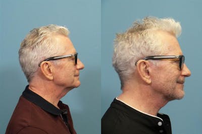 Facelift Before & After Gallery - Patient 335255 - Image 2