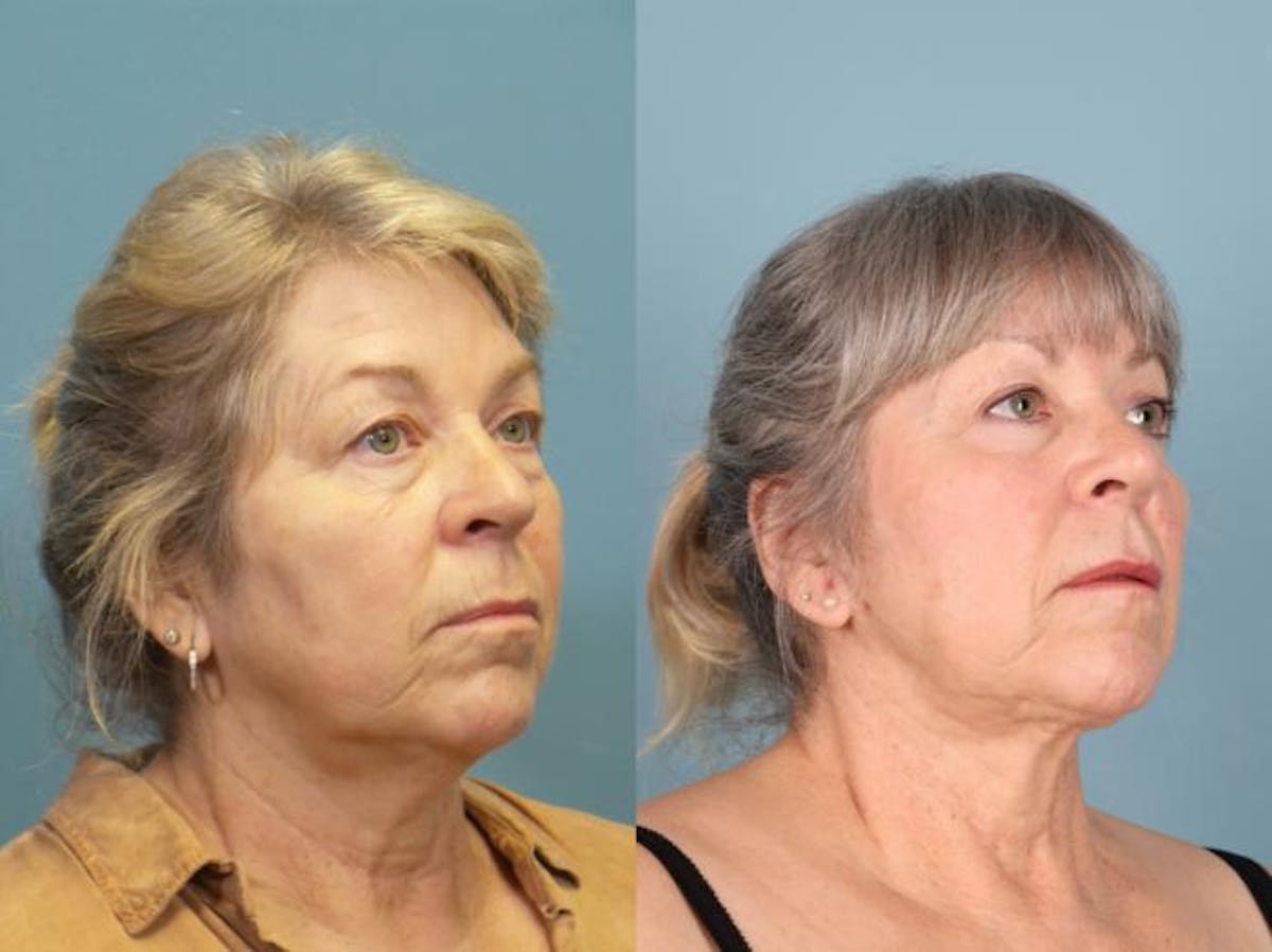 Facelift Before & After Gallery - Patient 268771 - Image 1