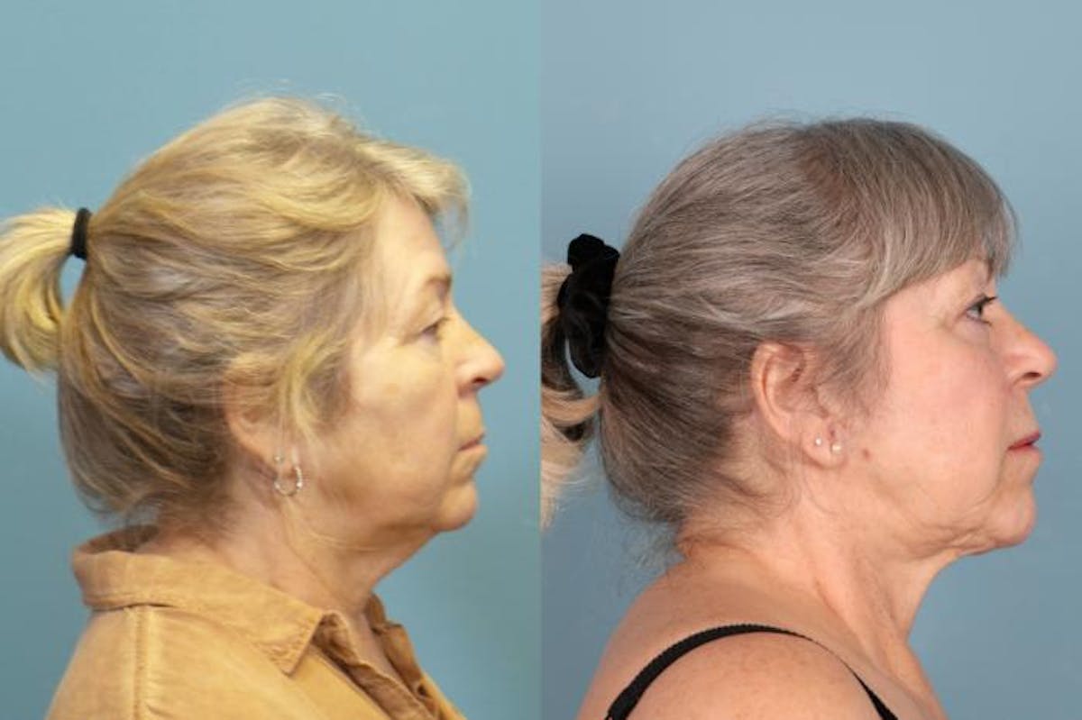 Facelift Before & After Gallery - Patient 268771 - Image 3