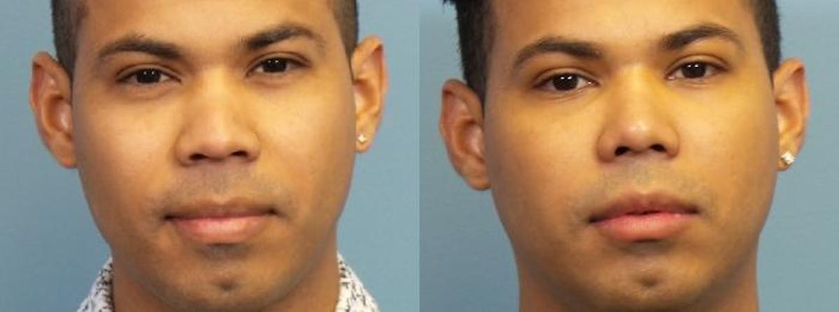 Rhinoplasty Before & After Gallery - Patient 353199 - Image 2