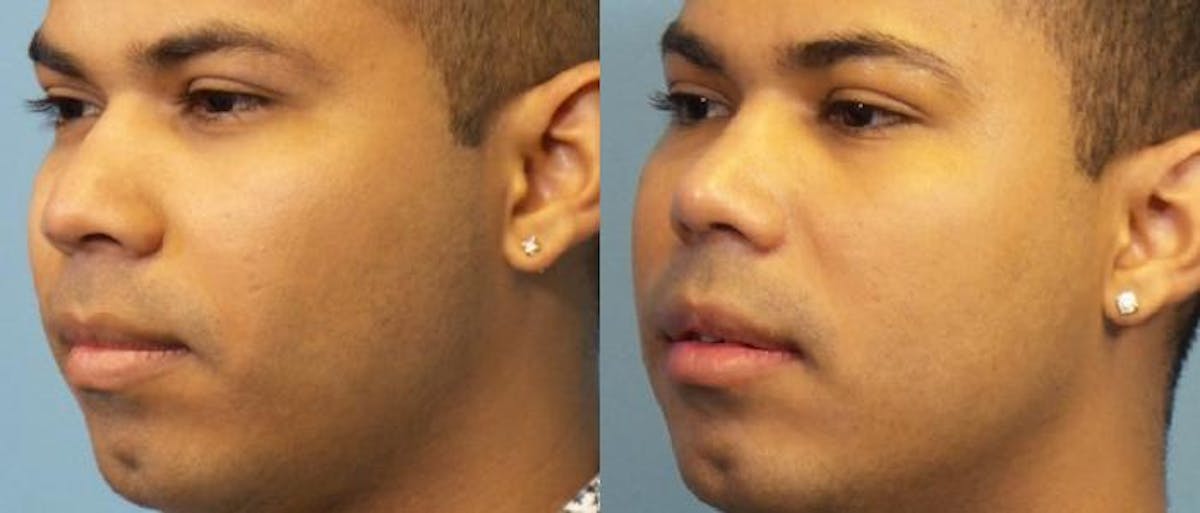 Rhinoplasty Before & After Gallery - Patient 353199 - Image 1