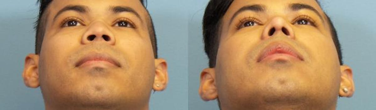 Rhinoplasty Before & After Gallery - Patient 353199 - Image 3