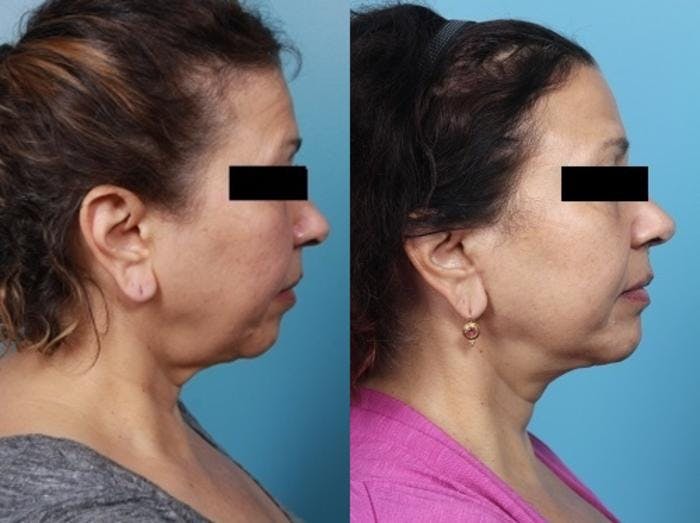 Neck Lift/ Lower Facelift Before & After Gallery - Patient 134504 - Image 1