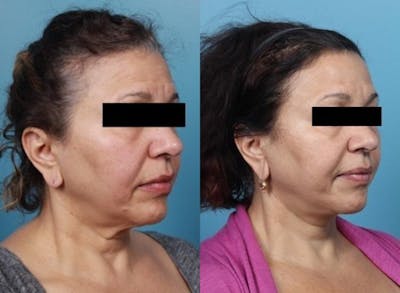 Neck Lift/ Lower Facelift Before & After Gallery - Patient 134504 - Image 2