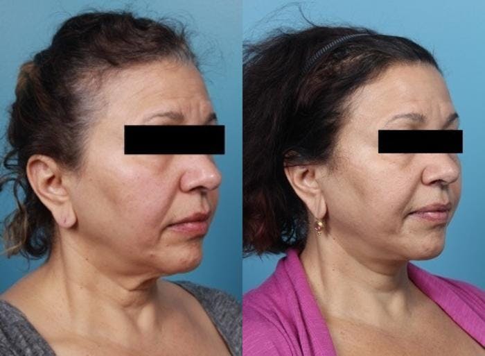 Neck Lift/ Lower Facelift Before & After Gallery - Patient 134504 - Image 2
