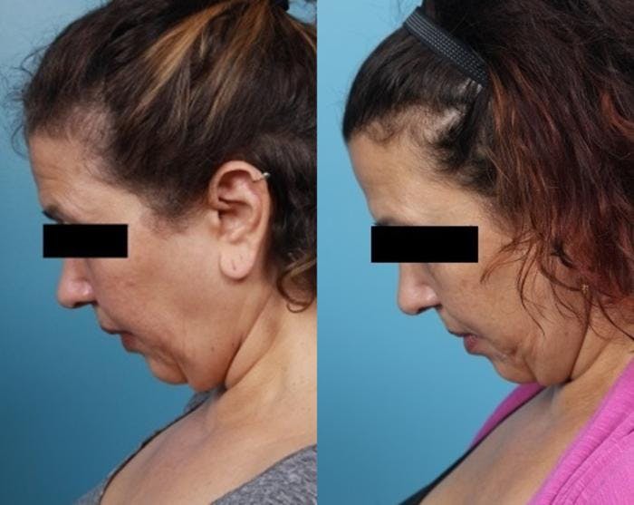 Neck Lift/ Lower Facelift Before & After Gallery - Patient 134504 - Image 3