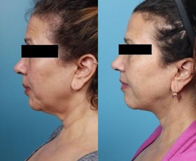 Neck Lift/ Lower Facelift Before & After Gallery - Patient 134504 - Image 4