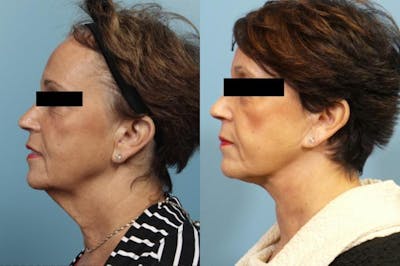 Neck Lift/ Lower Facelift Before & After Gallery - Patient 246540 - Image 1