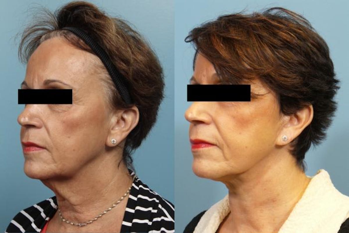 Neck Lift/ Lower Facelift Before & After Gallery - Patient 246540 - Image 2