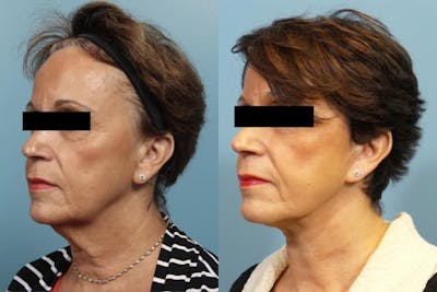 Neck Lift/ Lower Facelift Before & After Gallery - Patient 246540 - Image 2