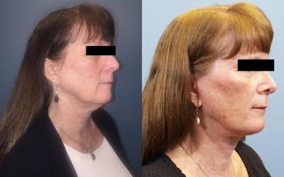 Neck Lift/ Lower Facelift Before & After Gallery - Patient 188684 - Image 1