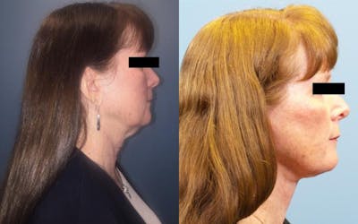 Neck Lift/ Lower Facelift Before & After Gallery - Patient 188684 - Image 2
