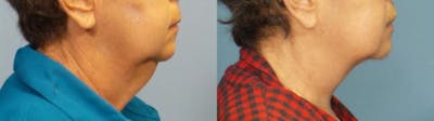 Neck Lift/ Lower Facelift Before & After Gallery - Patient 103746 - Image 1
