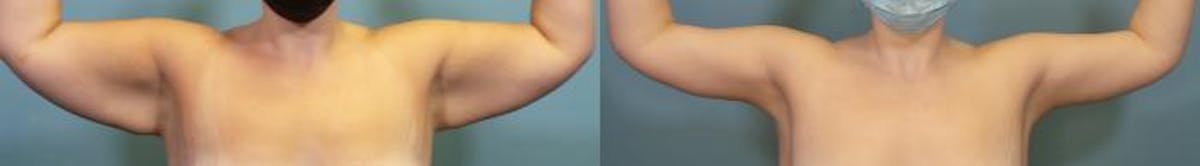 Arm Lift Before & After Gallery - Patient 390997 - Image 1