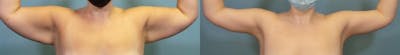 Arm Lift Before & After Gallery - Patient 390997 - Image 1