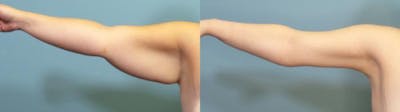 Arm Lift Before & After Gallery - Patient 390997 - Image 2