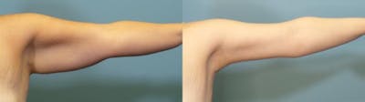 Arm Lift Before & After Gallery - Patient 390997 - Image 3