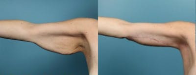 Arm Lift Before & After Gallery - Patient 224259 - Image 1