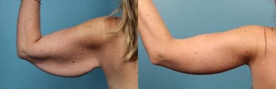 Arm Lift Before & After Gallery - Patient 224259 - Image 2