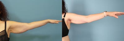 Arm Lift Before & After Gallery - Patient 392107 - Image 1