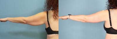 Arm Lift Before & After Gallery - Patient 392107 - Image 2