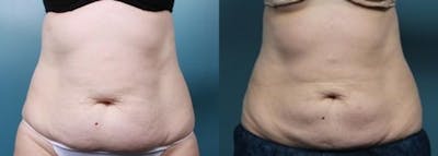 CoolSculpting Before & After Gallery - Patient 194322 - Image 1