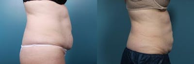 CoolSculpting Before & After Gallery - Patient 194322 - Image 2