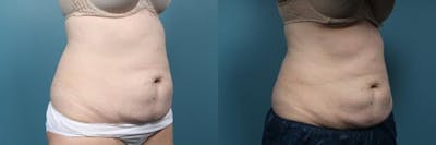 CoolSculpting Before & After Gallery - Patient 194322 - Image 3