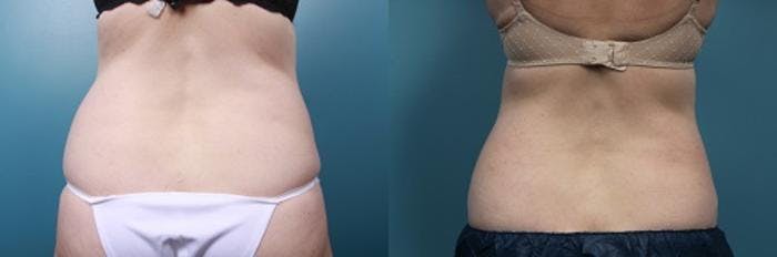 CoolSculpting Before & After Gallery - Patient 194322 - Image 4