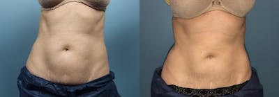 CoolSculpting Before & After Gallery - Patient 786902 - Image 1
