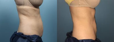 CoolSculpting Before & After Gallery - Patient 786902 - Image 2