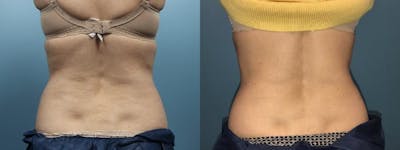 CoolSculpting Before & After Gallery - Patient 786902 - Image 3