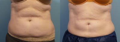 CoolSculpting Before & After Gallery - Patient 275813 - Image 1
