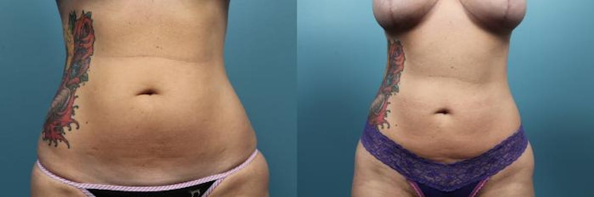 Liposuction Before & After Gallery - Patient 420354 - Image 1