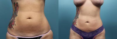 Liposuction Before & After Gallery - Patient 420354 - Image 1