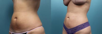 Liposuction Before & After Gallery - Patient 420354 - Image 2