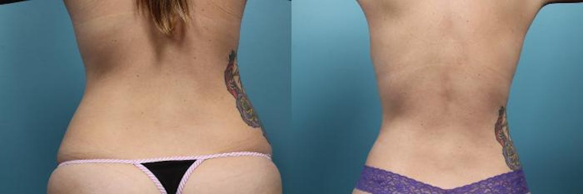 Liposuction Before & After Gallery - Patient 420354 - Image 3