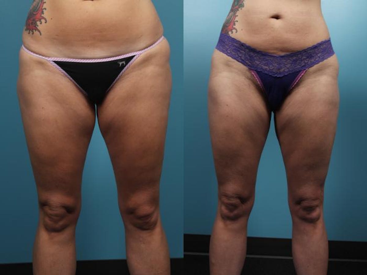 Liposuction Before & After Gallery - Patient 420354 - Image 4