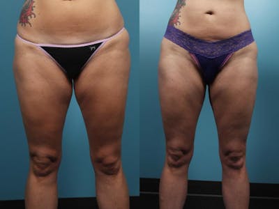 Liposuction Before & After Gallery - Patient 420354 - Image 4