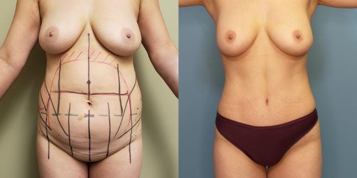 Liposuction Before & After Gallery - Patient 120391 - Image 1