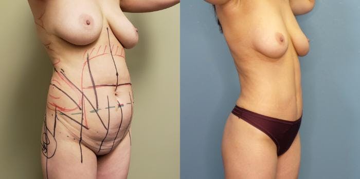 Liposuction Before & After Gallery - Patient 120391 - Image 2