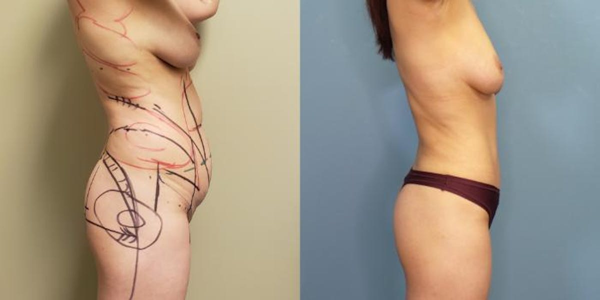Liposuction Before & After Gallery - Patient 120391 - Image 3