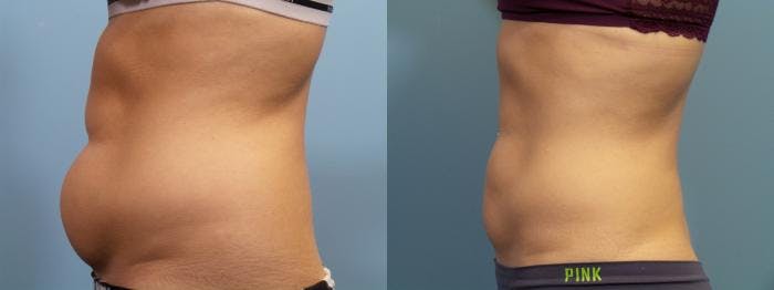 Liposuction Before & After Gallery - Patient 103472 - Image 1