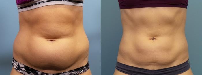 Liposuction Before & After Gallery - Patient 103472 - Image 2