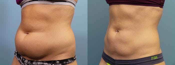 Liposuction Before & After Gallery - Patient 103472 - Image 3